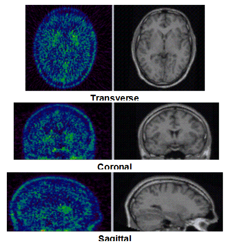 An example of PET/MRI scans where the subjects received a dose of 50 mg of preladenant.