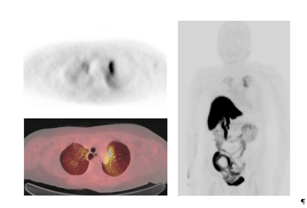 A series of 18F-FES-PET/CT images of patient Number 3 a 65-year-old-female with breast cancer