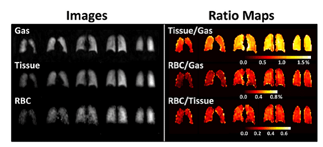 Figure 24 shows hyperpolarised xenon-129 MRI mapping of human lung using nmr active nuclei