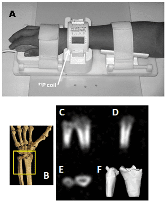 Figure 15 shows the phosphorus-31 solid-state MRI visualisation of bone mineral in human wrists