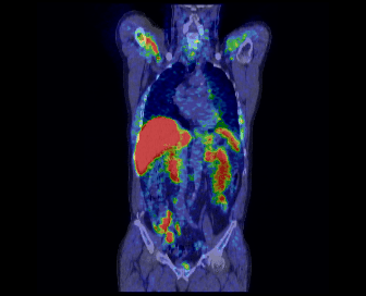 Figure 2 shows the carbon-11 choline PET/CT scan of the coronal view in the human body and prostate cancer