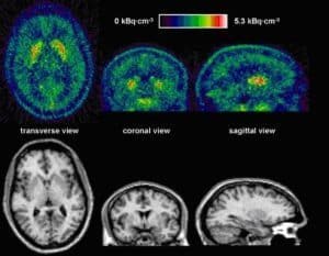 PET image of the human brain Using 11C-SCH442416