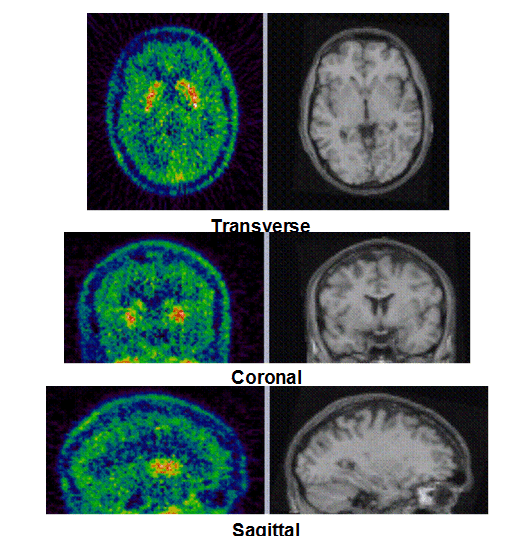 These PET/MRI scans of the brain were taken from people who received the lowest dose of 10 mg of preladenant.