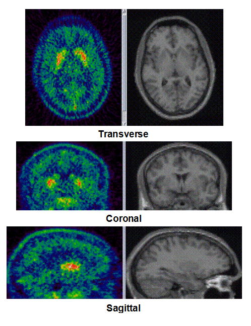 These pet images of the brain show the location of the carbon-11 radiotracer SCH 442416 after 3 minutes.
