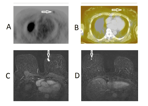 PET-CT images of a 65 year old female known as patient number 3 with breast cancer imaging