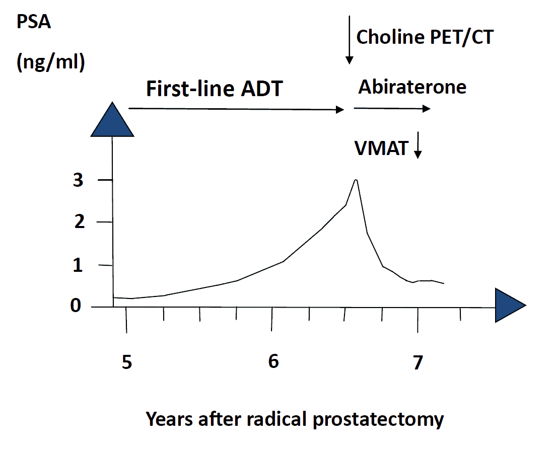 Figure 1 shows the PSA levels before and after treatment with abiraterone and volumetric modulated arc therapy