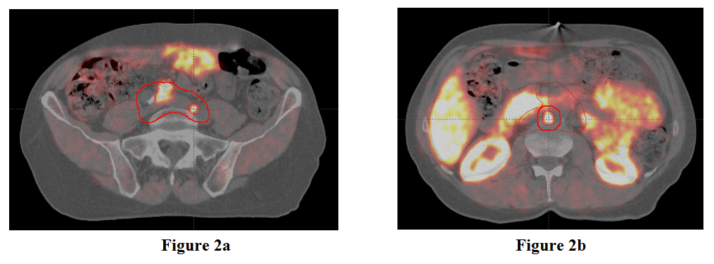 Figure 2 shows the caudal gross tumor volume and the planned treatment volume boost for prostate cancer