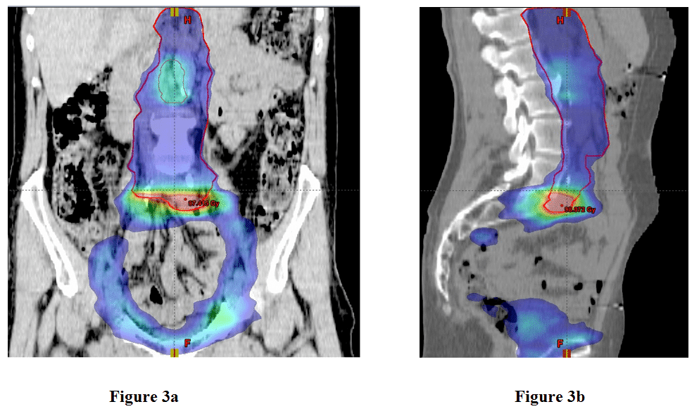 Figure 3 shows the coronal and sagittal dose distribution for the lymph nodes for the total VMAT treatments for prostate cancer