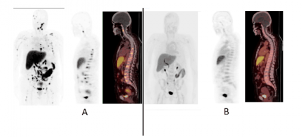 Estradiol PET/CT Imaging in Breast Cancer Patients