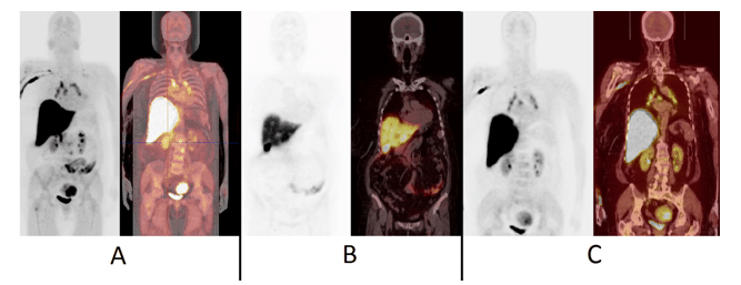 Figure 5 shows 18F-FES-PET images of a patient with T2N2M0 infiltrative ductal breast cancer