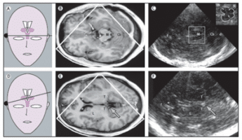 Figure 1 shows the corresponding MRI and transcranial sonography images of TCS in movement disorders