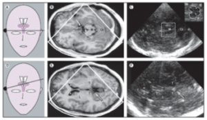 Ultrasonography is ultrasound imaging used in medical procedures