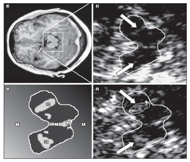 Figure 2 shows MRI and transcranial sonography at the mid brain level in one patient with multiple system atrophy and idiopathic Parkinson’s disease