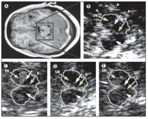 Figure 5 show MRI and TCS images of identical midbrain axial sections for the diagnosis of Parkinson's disease