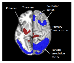 Facilitative glucose transporter GLUT1 in PETimaging | Open Medscience