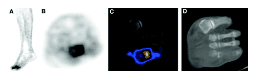 Figure 14 shows the [18F]FDG PET-CT diagnosis of diabetes-related osteomyelitis in the foot.