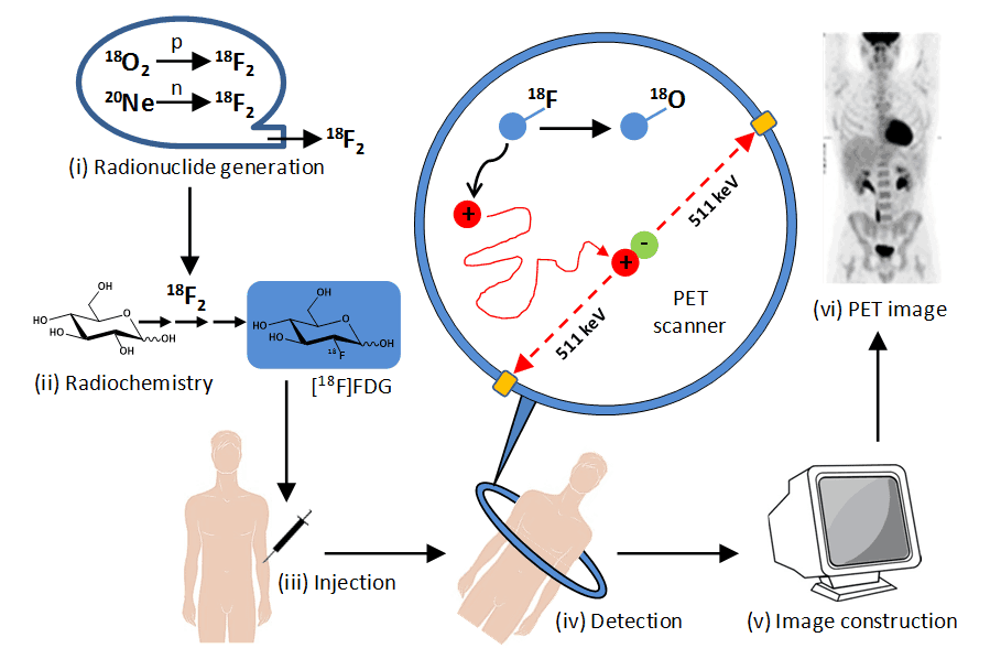 Stages in PET imaging of the human body refers to a series of steps involved in performing a PET scan, a type of medical imaging that uses radioactive tracers to create images of the body's metabolic activity