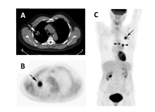 Figure 4 shows the [18F]FDG PET imaging of a lung cancer