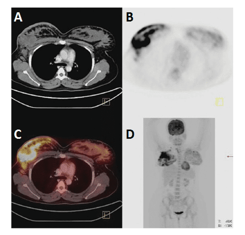 Figure 5 shows [18F]FDG PET imaging of a breast cancer