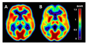 Facilitative glucose transporter GLUT1 in PETimaging | Open Medscience