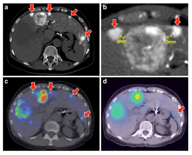 Comparison between 90Y-PET and 90Y-Bremsstrahlung images and dosimetry