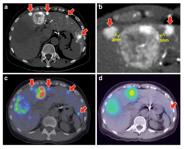 Dosimetry using 90Y microsphere therapy