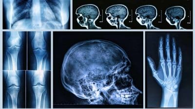 X-rays are a type of medical imaging that uses electromagnetic radiation to create images of the inside of the body