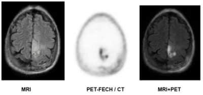 PET-MRI image of a brain tumour