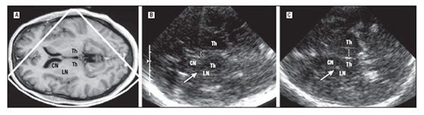 Ultrasonography is ultrasound imaging and can be used to obtain brain scans