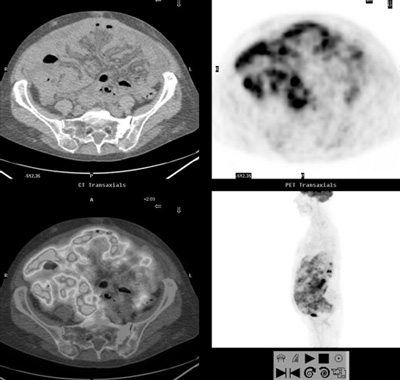 A diagnostic imaging tool to evaluate ovarian cancer