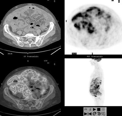 PET/CT Imaging - PET/CT Scans in Medford - Larchmont Imaging