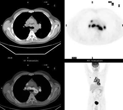 A PET-MRI image of sarcoidosis