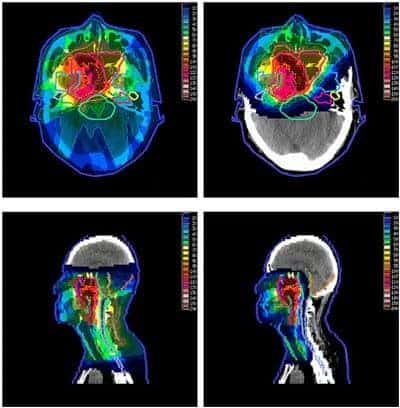 Proton Therapy