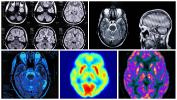 neuroendocrine tumors imaged with 68Ga-somatostatin in PET/CT