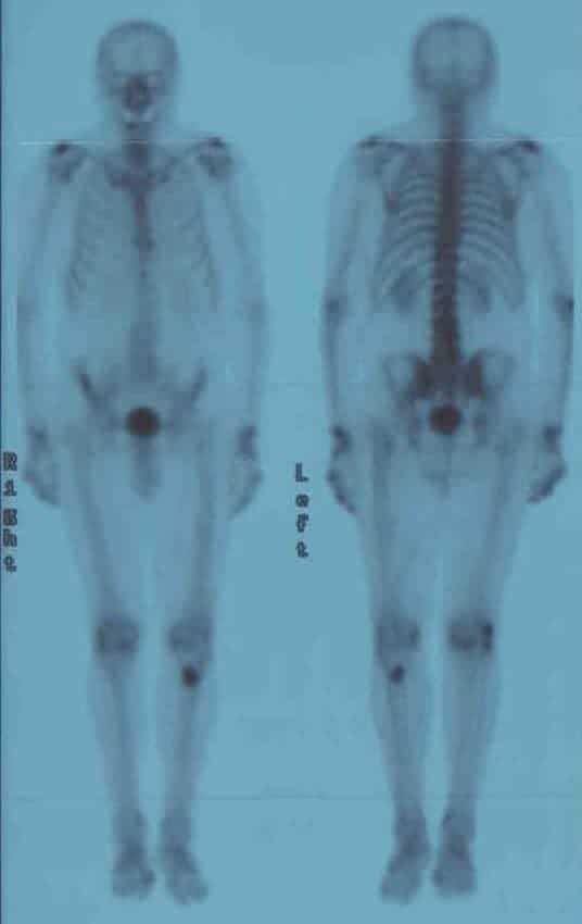Figure 1 shows the anterior and posterior view of whole-body bone scintigraphy from prostate cancer