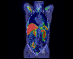 Coronal view of fused 11C-choline PET-CT scan of prostate cancer