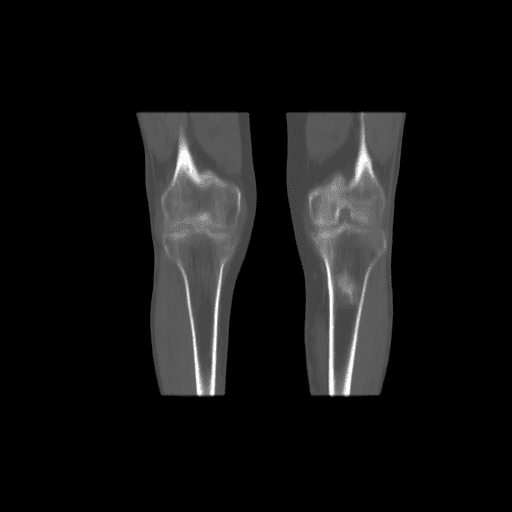 Figure 3B shows the coronal view of a CT scan of the inferior limb at knee height