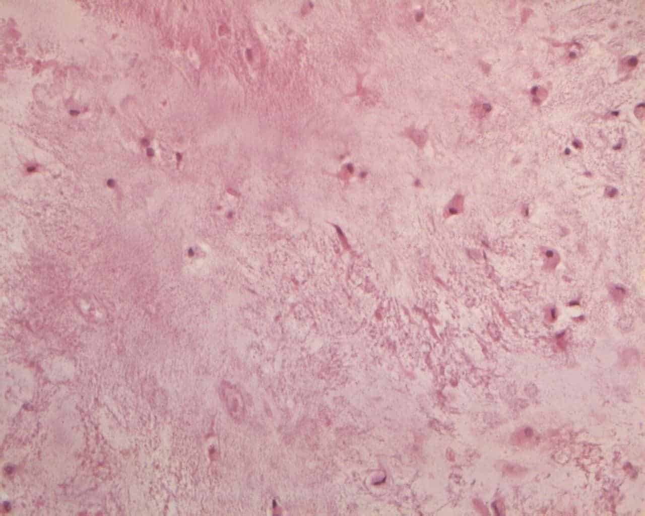 Figure 4A shows a typical enchondroma in the cartilage matrix