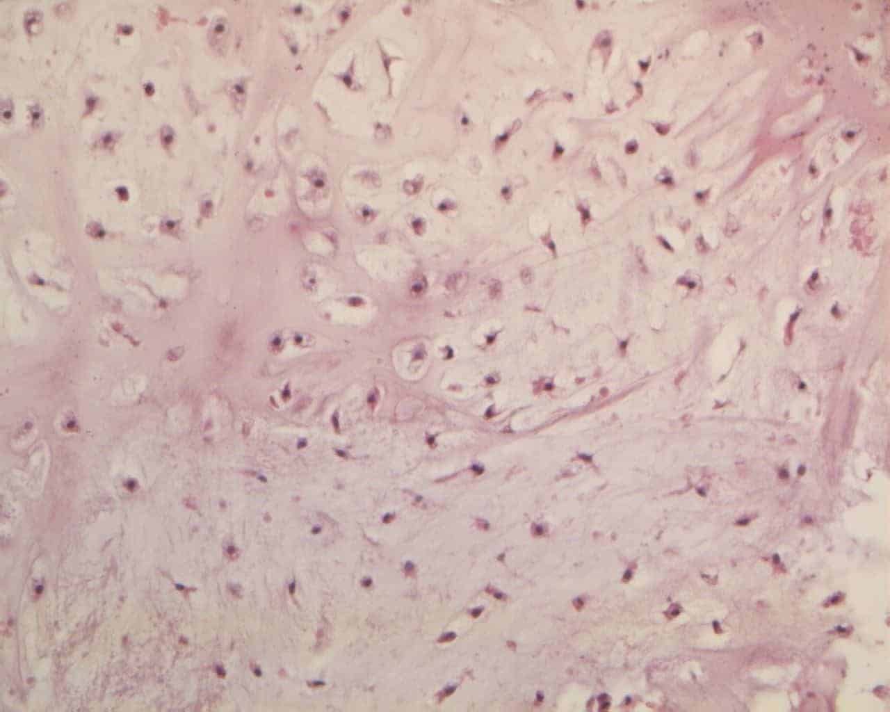 Figure 4B shows the chondrocytes which are finely granular eosinophilic cytoplasm of enchondroma