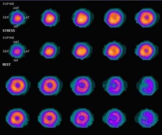 A series of SPECT scans examining myocardial perfusion imaging of the heart