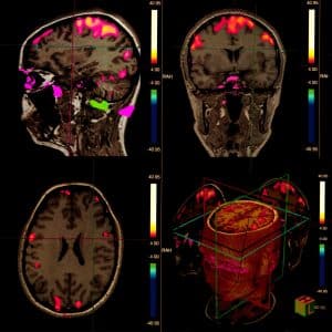 PET/MR in brain imaging