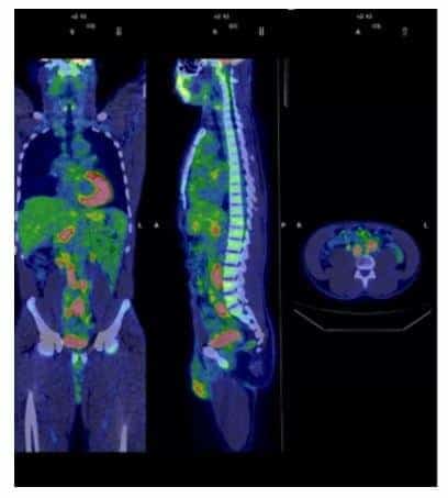 PET-FDG scan of tuberculosis
