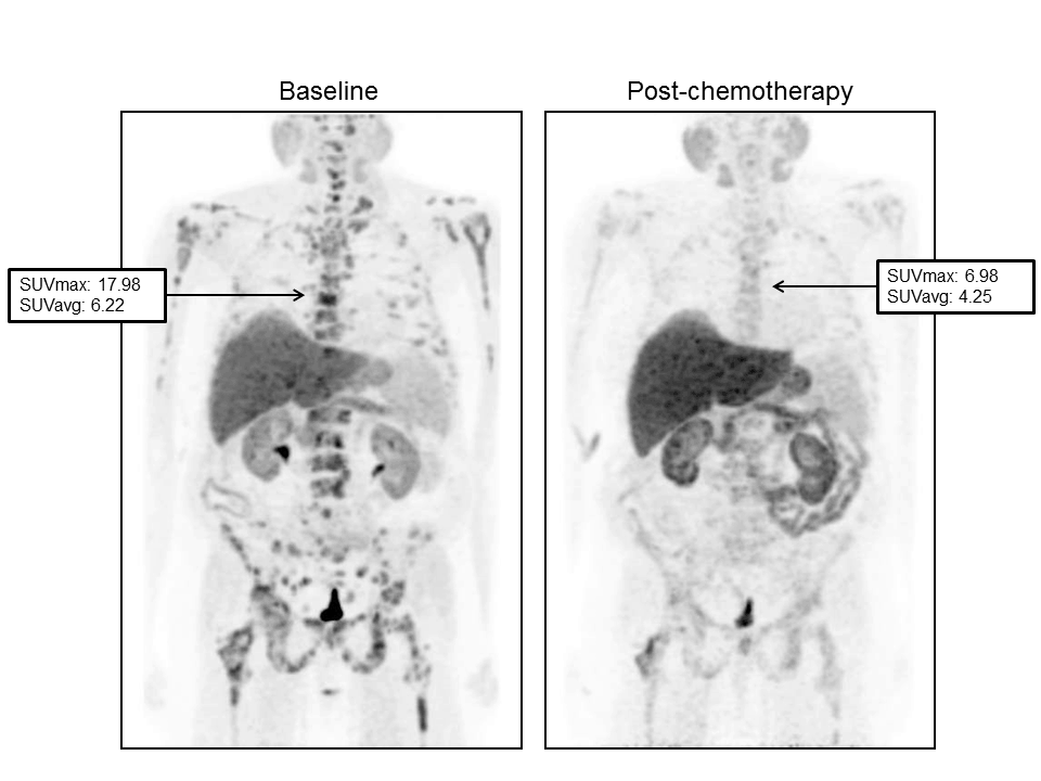 Figure 1 shows a serial FCH-PET scan of a 61-year-old patient with response to Abiraterone.