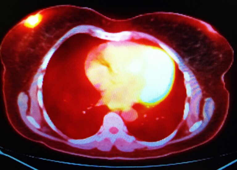 Positron Emission Mammography enhances breast cancer imaging with improved precision