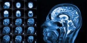 Magnetic Resonance Imaging (MRI) of the brain