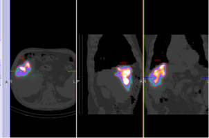 SPECT-CT Activity Quantification in 99mTc-MAA Acquisitions