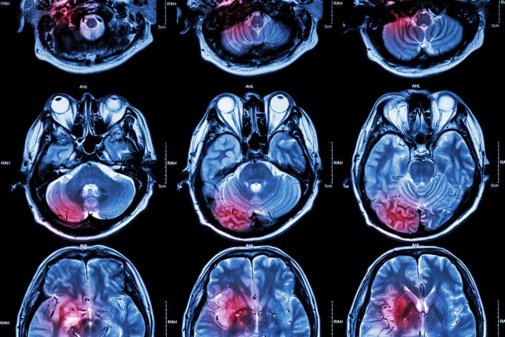 Hyperpolarized carbon-13 pyruvate MRI improves metabolic imaging for disease diagnosis