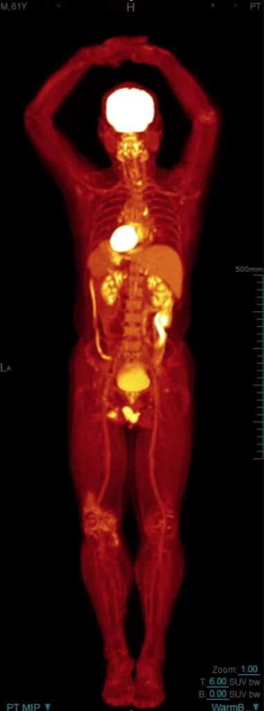 PET scan (positron emission tomography) is a type of medical imaging that uses a small amount of radioactive material to produce three-dimensional images of the body's metabolic activity