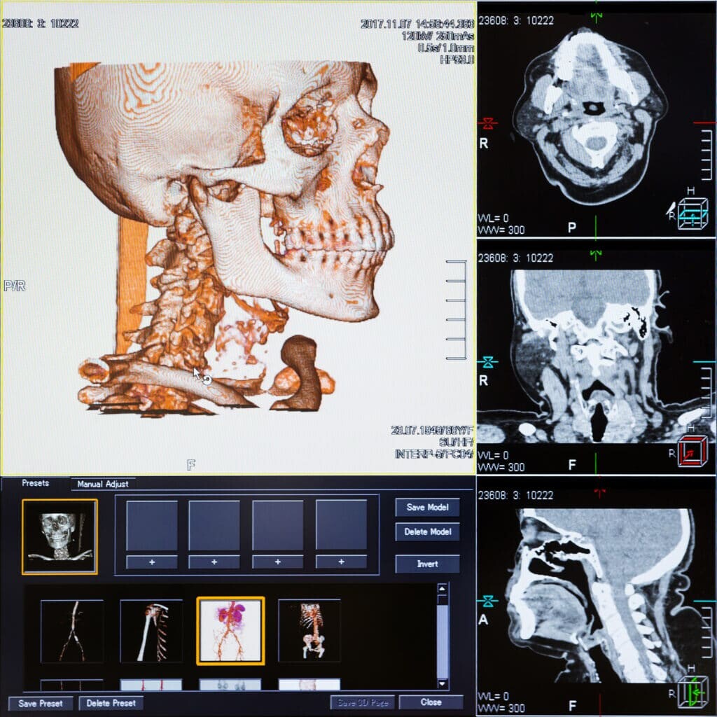 CT scans (computed tomography) are a type of medical imaging that uses X-rays and computer technology to create detailed, cross-sectional images of the bod