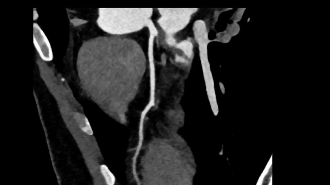 Fractional Flow Reserve-Computed Tomography revolutionises cardiac diagnostics, enabling noninvasive, accurate coronary artery assessment.